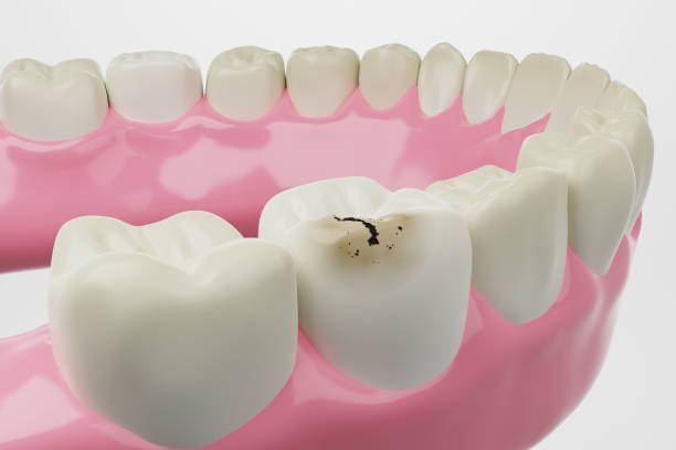 carie dentaire fond blanc - preventative maintenance photos et images de collection