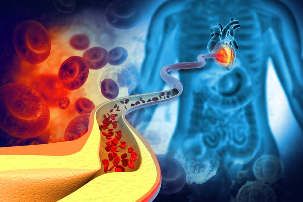 istock Cholesterol plaque in artery.3d illustration 1496660355