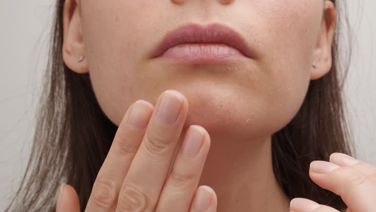 A young Caucasian woman touches her face with her hands. Chemical peeling. Skin peels and causes discomfort