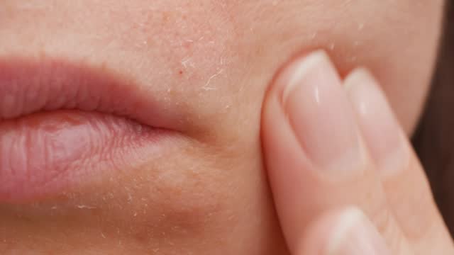 A young Caucasian woman rubs her face next to her lips with her hands. Close-up. Peeling skin after solarium