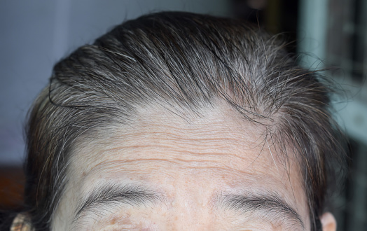 Skin creases or wrinkles at forehead of Southeast Asian, Myanmar or Burmese elder woman. Symptom of aging. Front view.