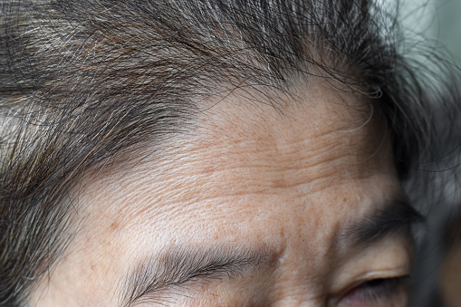 Skin creases or wrinkles at forehead of Southeast Asian, Myanmar or Burmese elder woman. Symptom of aging. Lateral view.