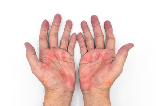 Palmar erythema often called liver palms in both hands of Southeast Asian, Myanmar man. Isolated on white background.