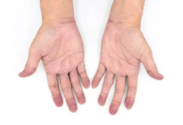 Cyanotic hands or central cyanosis or blue hands at Southeast Asian, Chinese young man with congenital heart disease.