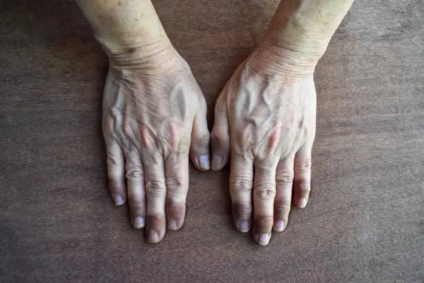Cyanotic hands or peripheral cyanosis or blue hands at Southeast Asian, Chinese woman with congenital heart disease.