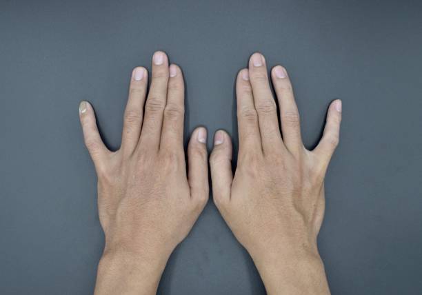 istock Bilateral little finger deviation in Asian young man. Bilateral hand deformities. Abnormal fingers extension. 1497109137