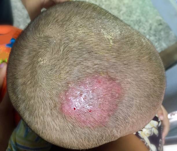 tinea capitis or fungal infection on scalp of southeast asian, burmese two years old  child . - shaved head imagens e fotografias de stock