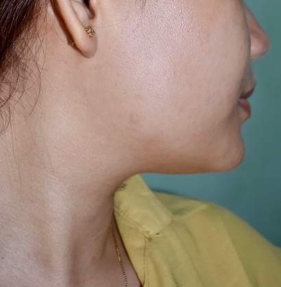 Jaw fat and chin fat of Southeast Asian, Myanmar beautiful young woman. Impending double chin. Lateral view.