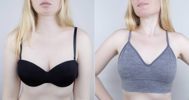 istock Before and after. Uncomfortable bra. Bra marks. Non-anatomical underwear causing squeezing and rubbing of mammary glands. Mastopathy and mastalgia. Women choose convenient, and discarded uncomfortable 1497130699