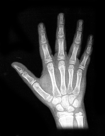 X-ray of a hand of a 8 year old child