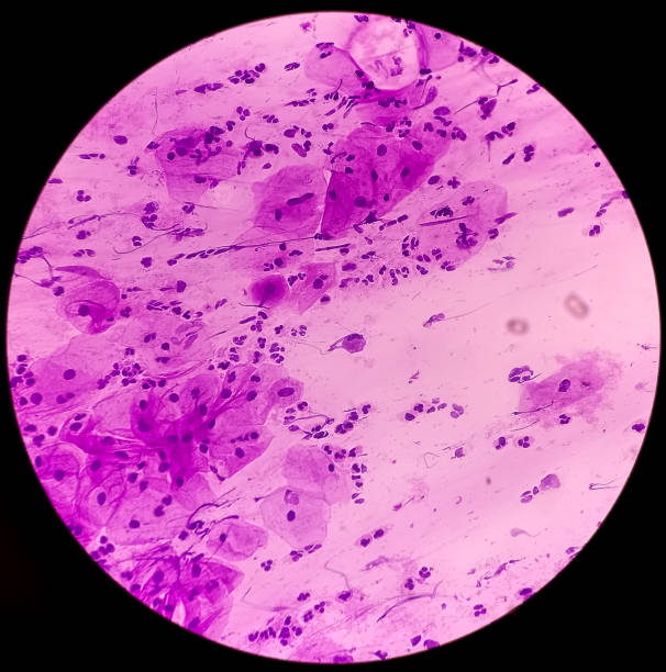 istock Paps smear: Inflammatory smear with HPV related changes. Cervical cancer. SCC 1497174919
