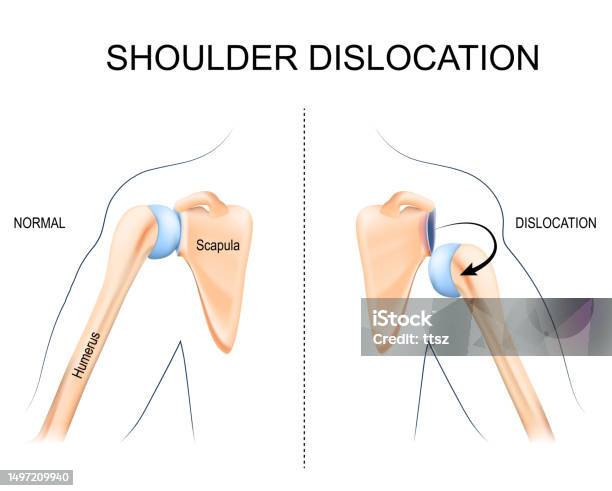 Dislocation Body Shoulder Dislocation Humerus Bone Trauma Stock Illustration - Download ...
