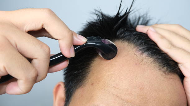 istock Close up of man applying derma roller on his scalp 1497312230