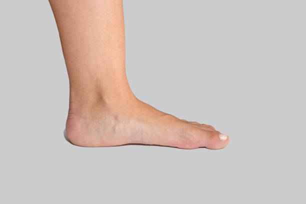 pied plat de la femme montrant une voûte plantaire manquante qui peut causer un désalignement et des problèmes orthopédiques sur fond blanc - misalignment photos et images de collection