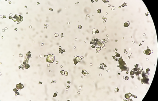 Uric acid crystal, Calcium oxalate dihydrate in urine sediment.