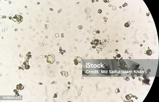 istock Uric acid crystal, Calcium oxalate dihydrate in urine sediment. 1498044373