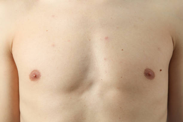 istock Concept of skin problems, breast of young man 1498216877