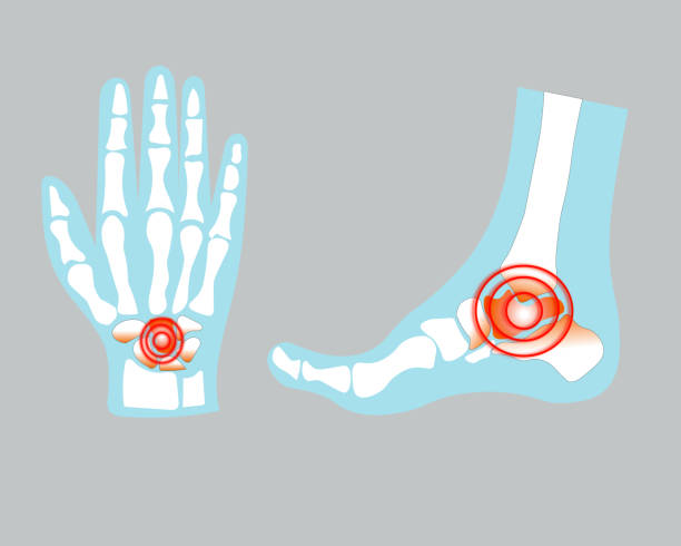 damage to human hand and foot bones damage to human hand and foot bones human joint stock illustrations