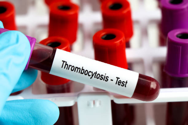 istock thrombocytosis test, blood sample to analyze in the laboratory 1498277393
