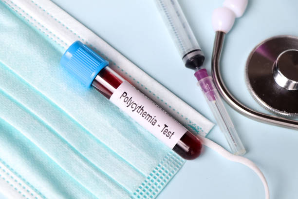 istock Polycythemia test, blood sample to analyze in the laboratory 1498277609