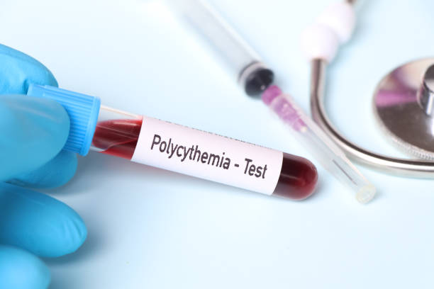 istock Polycythemia test, blood sample to analyze in the laboratory 1498277635