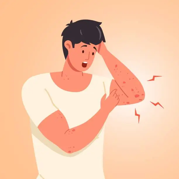 Vector illustration of Man scratching skin. Guy scratch sensitive skins on itchy hand, scabies eczem rash inflammation or chickenpox symptoms, mosquito infection food allergy concept vector illustration