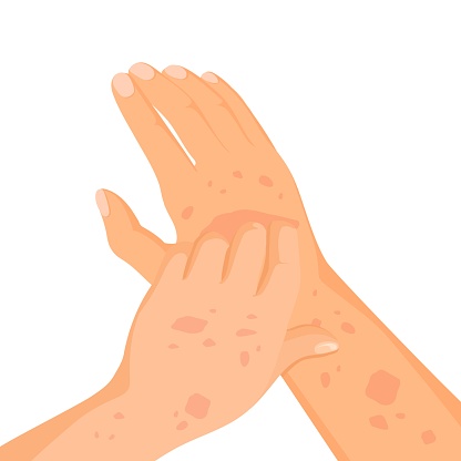 Rash skin on hand. Rashes itching hands scratch arm in red spot, dermatitis allergy symptoms itchy hives medicine pele virus eczema urticaria irritation disease vector illustration of skin disease