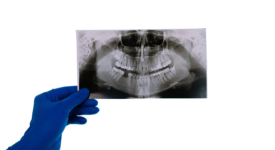 dentist holding snapshot the patient's tooth isolated on white background, the doctor analyzes the jaw image