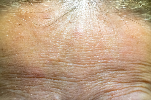 The forehead of a woman with problematic skin.