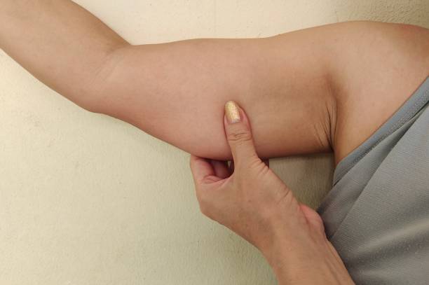 istock The flabbiness adipose sagging skin under the arm. 1498815134