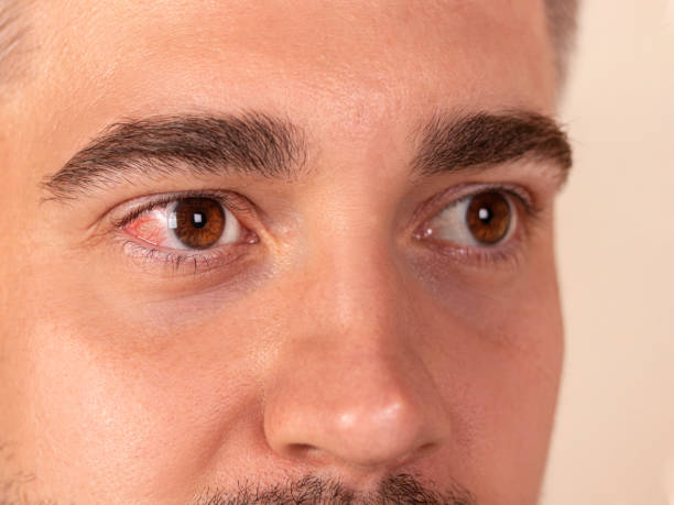 istock Man with red inflamed eye. Allergic reaction 1498870718