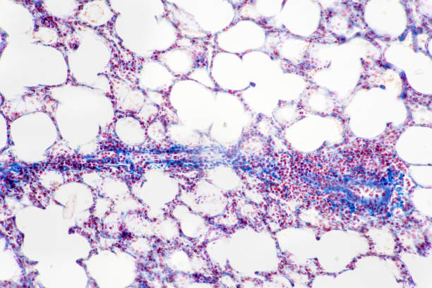 istock Human lung pathology under light microscope, The lungs is organs of the respiratory system in humans. 1498876731