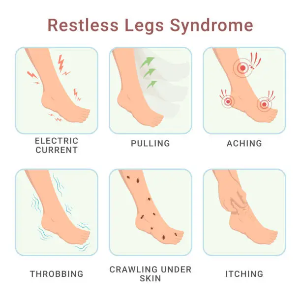 Vector illustration of Restless legs syndrome electric current pulling aching throbbing crawling skin itching vector flat