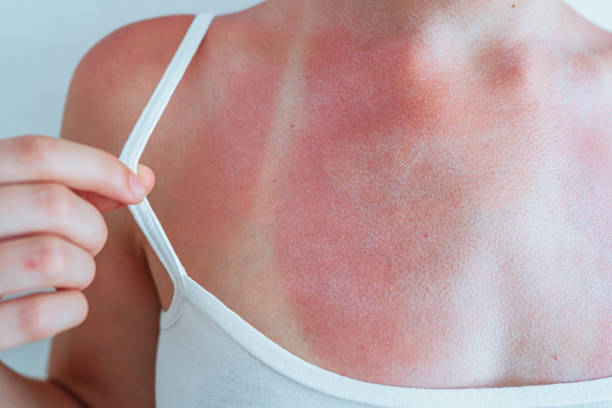istock Swimsuit strap marks on young woman's sunburned skin 1499111199