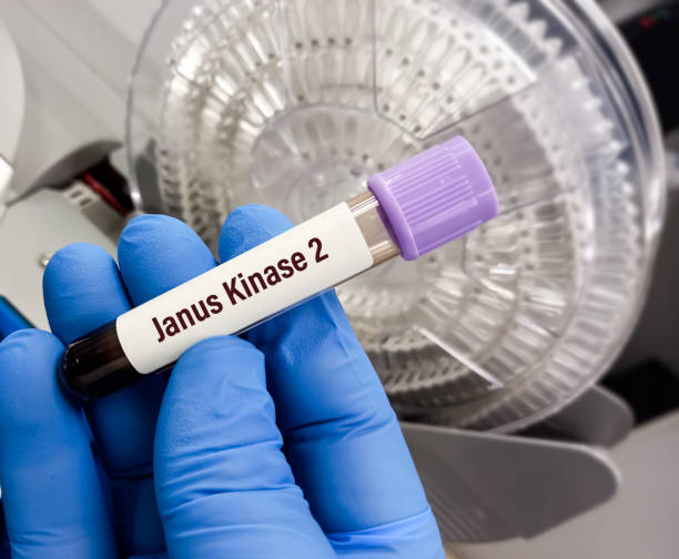 próbka krwi do testu genu janus kinase 2(jak2), w celu zdiagnozowania zaburzeń szpiku kostnego. należą do nich: nadpłytkowość samoistna, czerwienica prawdziwa lub pierwotne zwłóknienie szpiku. - czerwienica zdjęcia i obrazy z banku zdjęć