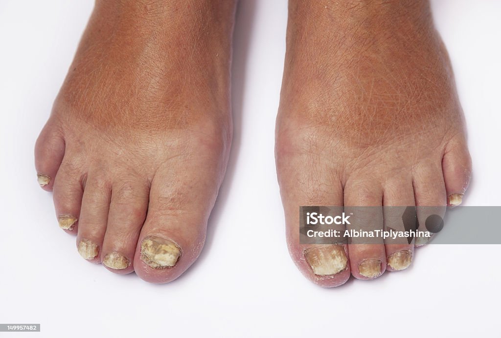 Athlete's foot Fungoid disease of a nail Bad Condition Stock Photo