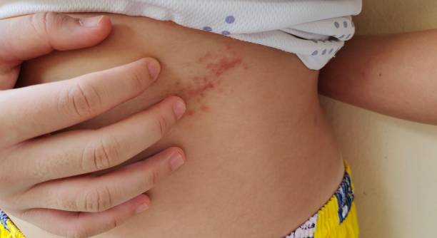 istock The chronic dermatitis, rash, hives, itchy, itching on the body. 1499659518