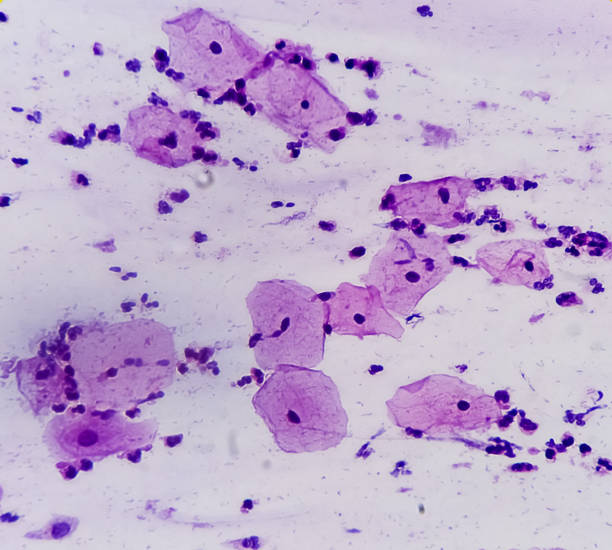 istock Pap's smear. Inflammatory smear with HPV related changes. Cervical cancer. SCC. 1499735006