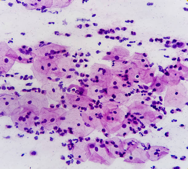 istock Pap's smear. Inflammatory smear with HPV related changes. Cervical cancer. SCC. 1499735020