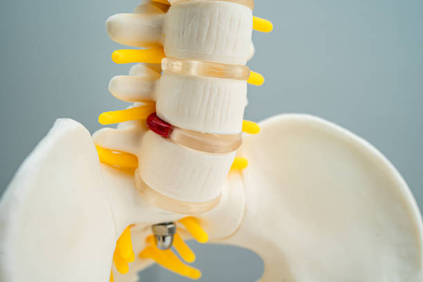 la columna lumbar desplazó el fragmento de hernia discal, el nervio espinal y el hueso. modelo para tratamiento médico en el departamento de ortopedia. - slipped disc fotografías e imágenes de stock