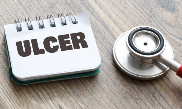 istock The word ULCER in a notebook next to a stethoscope. 1499944520