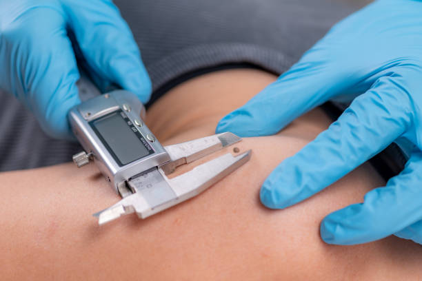 istock Dermatologist Measures Mole Safeguarding Skin Health 1499947400