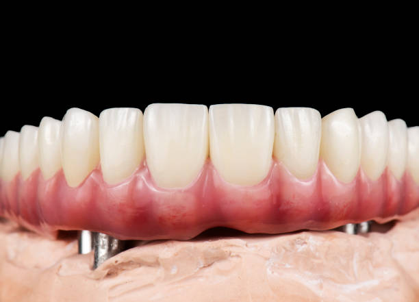 istock Emax ceramics on hybrid implant bridge 1500067685
