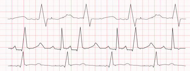 istock Set of black heartbeat diagrams on red graph paper. ECG electrocardiogram chart. Cardiac rhythm line. Cardio test signs. Vector graphic illustration 1500142278