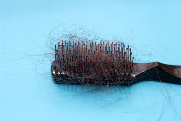 istock Hairs loss fall in comb on blue background. 1500176720