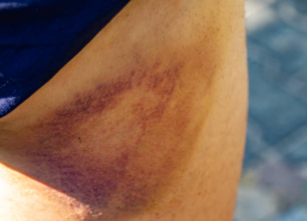 istock painless bruise on thigh trauma 1500245047