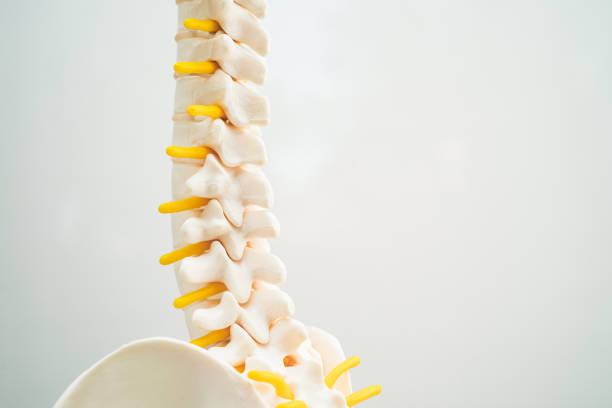 la columna lumbar desplazó el fragmento de hernia discal, el nervio espinal y el hueso. modelo para tratamiento médico en el departamento de ortopedia. - slipped disc fotografías e imágenes de stock