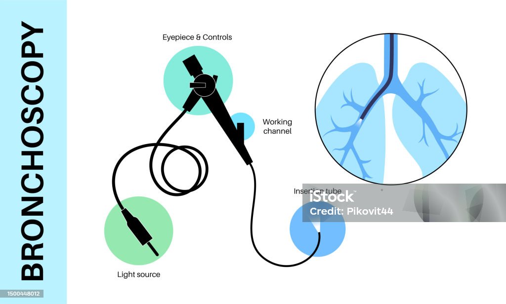 Bronchoscopy Visualization Bronchoscopy Procedure Concept Stock Illustration - Download Image Now ...