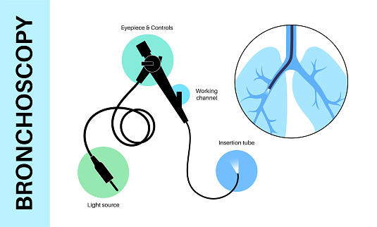 Bronchoscopy Checklist.pdf Bronchoscopy Procedure Concept Stock Illustration - Download Image Now ...