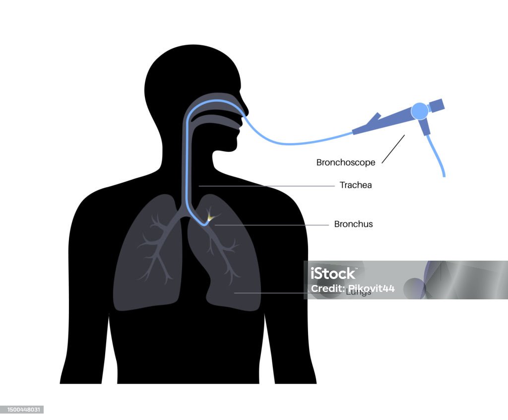 Bronchoscope Position Bronchoscopy Procedure Concept Stock Illustration - Download Image Now ...